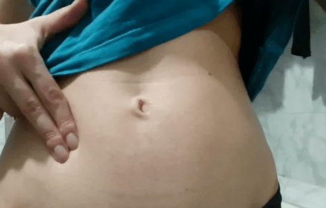 Inchaço abdominal devido à triquinose
