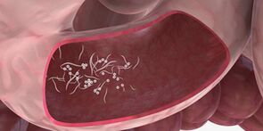 O uso de trigêmeos para remover parasitas